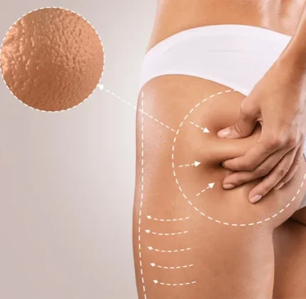trattamenti-cellulite